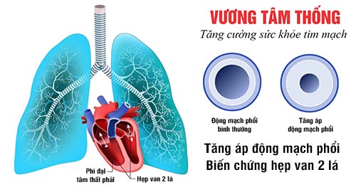 Tăng áp động mạch phổi là biến chứng hẹp van 2 lá nguy hiểm