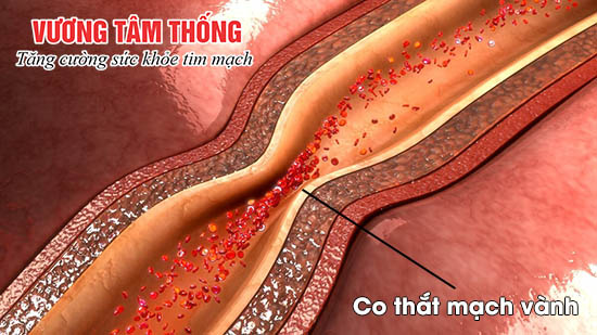  Co thắt mạch vành làm giảm lưu lượng máu đến nuôi tim