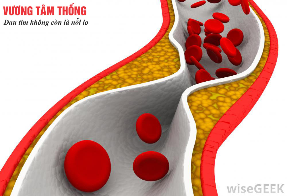Xơ vữa động mạch vành – Dấu hiệu nhận biết và biện pháp phòng ngừa