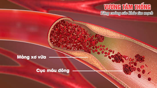 Cục máu đông gây tắc nghẽn mạch máu