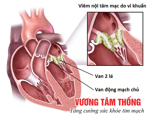 Thấp tim là nguyên nhân hở van tim phố biến nhất