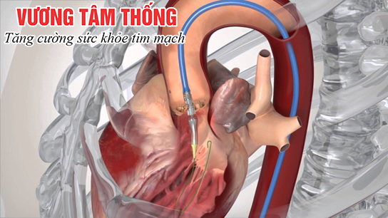 hủ thuật thông tim có thể gây tổn thương van tim