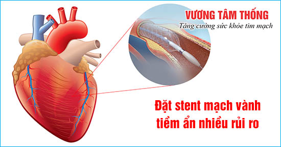 Biến chứng sau đặt stent mạch vành là nguyên nhân làm giảm tuổi thọ của người bệnh