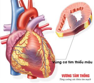 Thiếu máu cơ tim thầm lặng là gì? Giải pháp trị hiệu quả